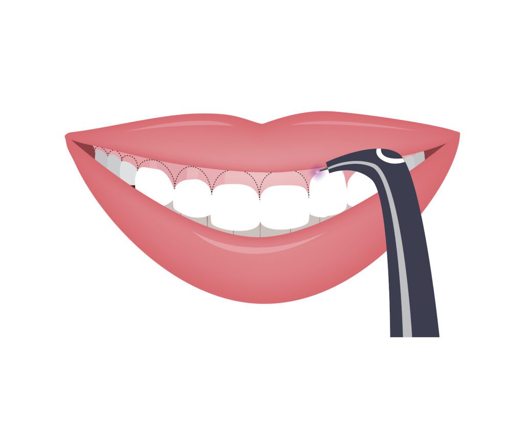 Laser dentistry can be a safe and effective way to treat a variety of soft-tissue dental issues, such as gum disease.