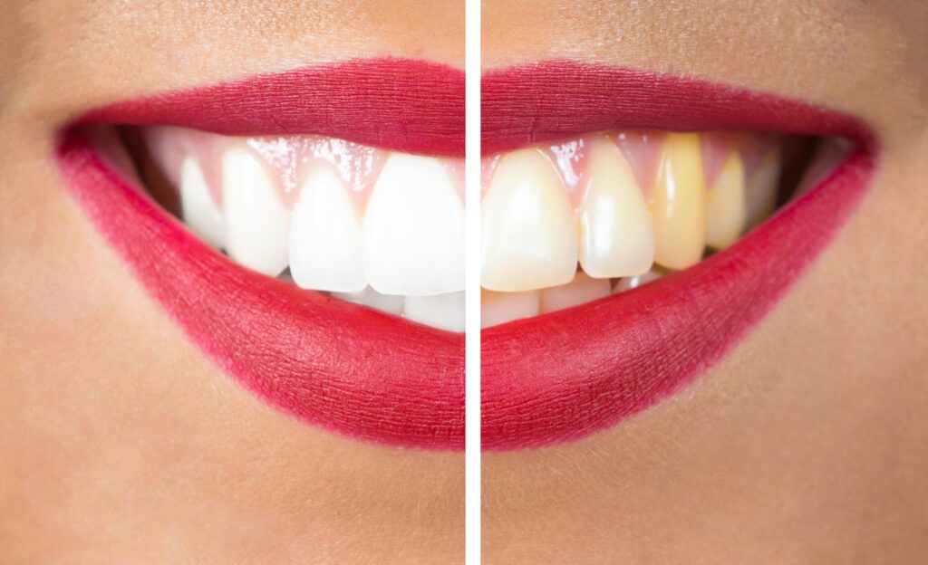 Many people seek whiter teeth for a brighter smile. Professional teeth whitening offers effective solutions.